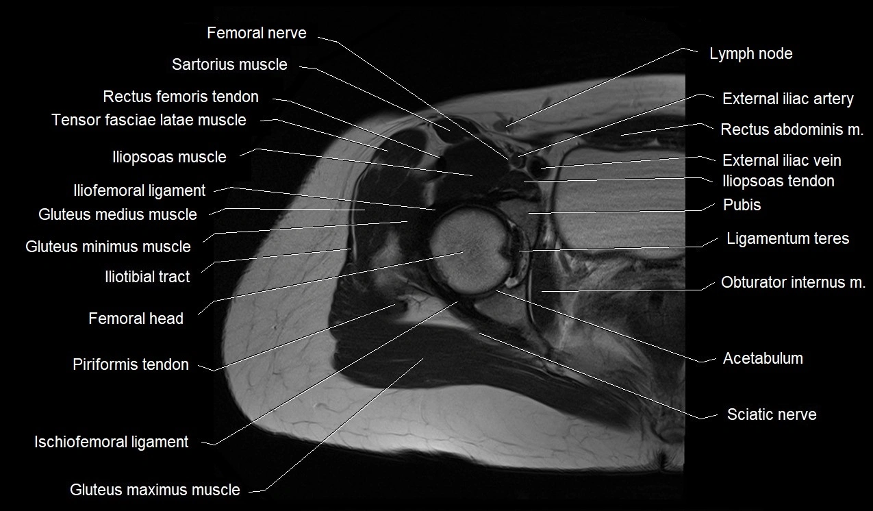 MRI thigh cross sectional anatomy image 6.webp